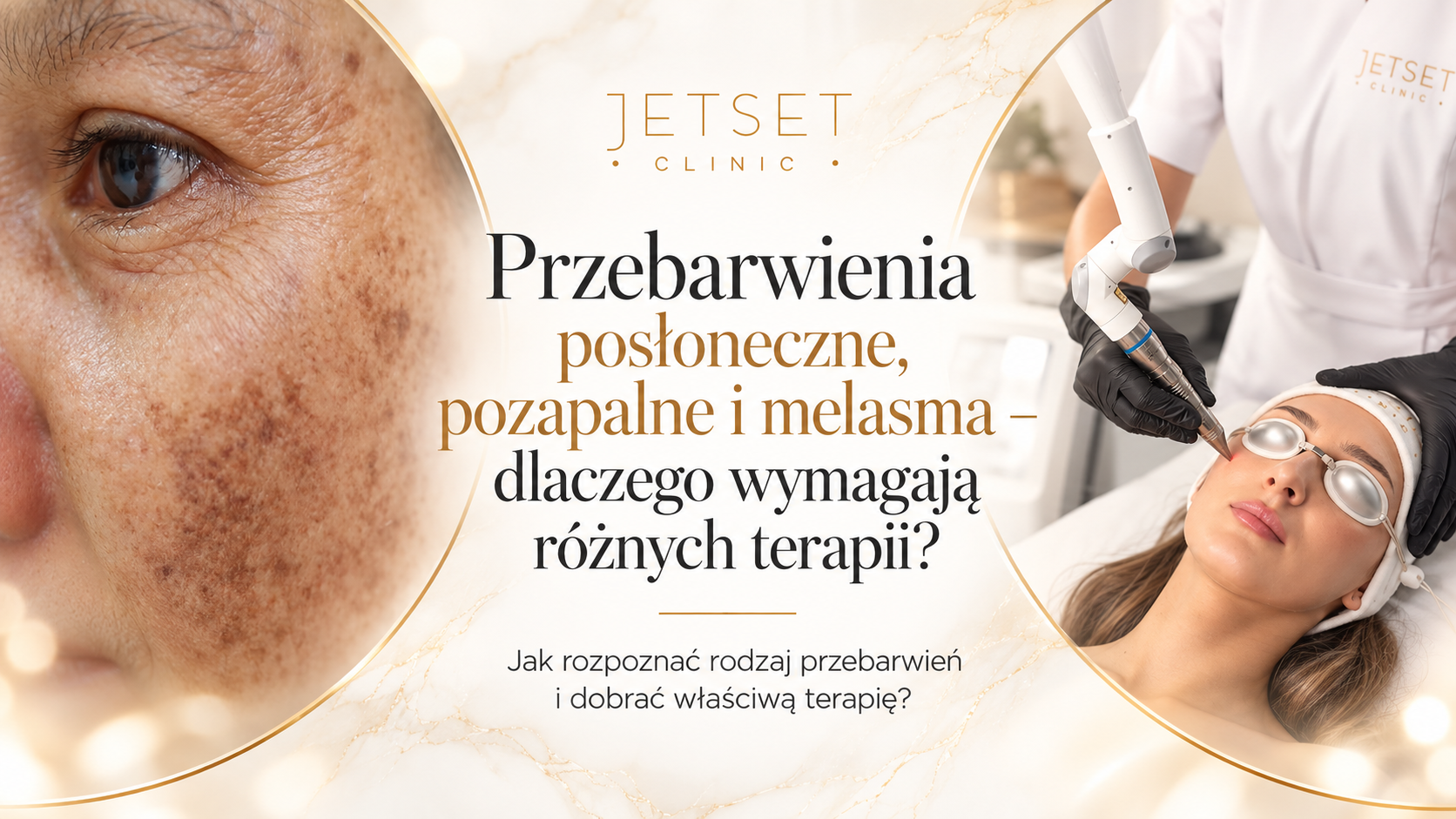 PRzebarwienia posloneczne i pozapalane, melasma